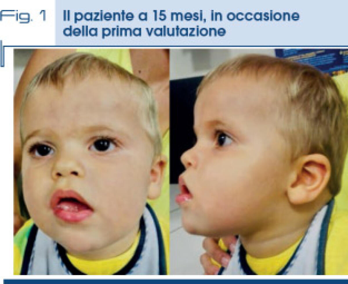 III Conferenza Nazionale sulla sindrome di Kleefstra: importanti risposte da parte del MIM - 
